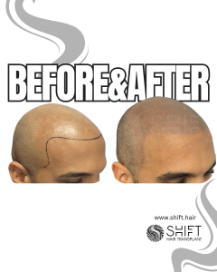 Scalp Micropigmentation for the Shaved Look Turkey Before After SHIFT Hair Transplant in Istanbul 39 3