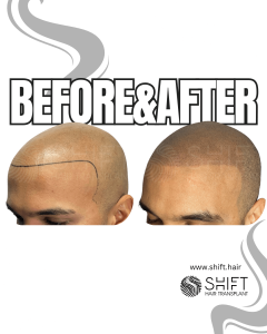 Scalp Micropigmentation for the Shaved Look Turkey Before After SHIFT Hair Transplant in Istanbul 40 3