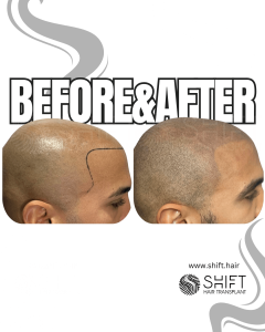 Scalp Micropigmentation for the Shaved Look Turkey Before After SHIFT Hair Transplant in Istanbul 41 3