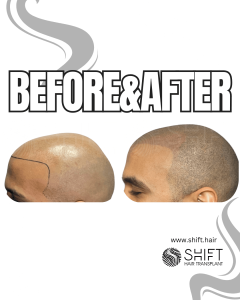 Scalp Micropigmentation for the Shaved Look Turkey Before After SHIFT Hair Transplant in Istanbul 42 3