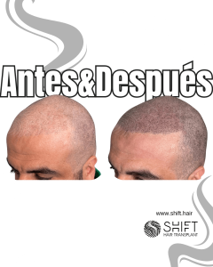 Antes y después de una micropigmentación capilar para un look afeitado en Turquía en SHIFT Hair en Estambul 46 3
