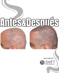 Antes y después de una micropigmentación capilar para un look afeitado en Turquía en SHIFT Hair en Estambul 48 3