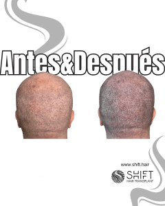 Antes y después de una micropigmentación capilar para un look afeitado en Turquía en SHIFT Hair en Estambul 49 3