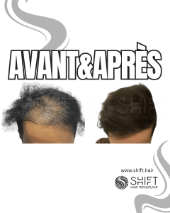 Avant Après de la greffe de cheveux de modèle féminin en Turquie chez SHIFT Hair à Istanbul 06 3
