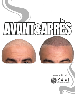 Avant Après de la micropigmentation du cuir chevelu pour un look rasé en Turquie chez SHIFT Hair à Istanbul 43 3