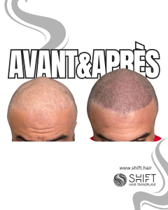 Avant Après de la micropigmentation du cuir chevelu pour un look rasé en Turquie chez SHIFT Hair à Istanbul 44 3