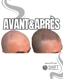 Avant Après de la micropigmentation du cuir chevelu pour un look rasé en Turquie chez SHIFT Hair à Istanbul 45 3