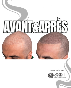 Avant Après de la micropigmentation du cuir chevelu pour un look rasé en Turquie chez SHIFT Hair à Istanbul 46 3