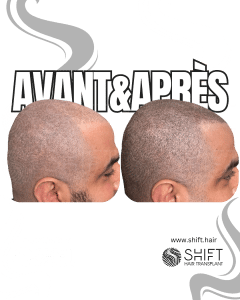 Avant Après de la micropigmentation du cuir chevelu pour un look rasé en Turquie chez SHIFT Hair à Istanbul 47 3