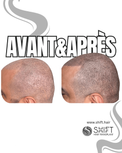 Avant Après de la micropigmentation du cuir chevelu pour un look rasé en Turquie chez SHIFT Hair à Istanbul 48 3