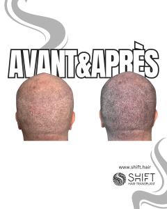 Avant Après d'une micropigmentation du cuir chevelu pour la zone donneuse après une greffe de cheveux en Turquie chez SHIFT Hair à Istanbul 08 3