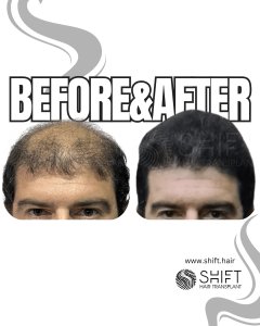 Female Pattern Hair Transplant Turkey Before After SHIFT Hair Transplant in Istanbul 05 3