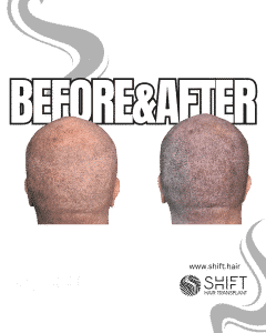 Scalp Micropigmentation for Donor Area Correct and FUT Scar Turkey Before After SHIFT Hair Transplant in Istanbul 08 3