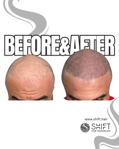 Scalp Micropigmentation for the Shaved Look Turkey Before After SHIFT Hair Transplant in Istanbul 44 3