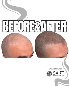 Scalp Micropigmentation for the Shaved Look Turkey Before After SHIFT Hair Transplant in Istanbul 45 3
