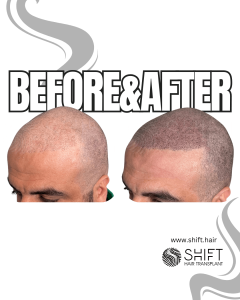 Scalp Micropigmentation for the Shaved Look Turkey Before After SHIFT Hair Transplant in Istanbul 46 3