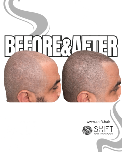Scalp Micropigmentation for the Shaved Look Turkey Before After SHIFT Hair Transplant in Istanbul 47 3