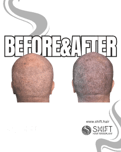 Scalp Micropigmentation for the Shaved Look Turkey Before After SHIFT Hair Transplant in Istanbul 49 3