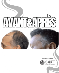 Avant Après de Greffe de Cheveux pour Calvitie Norwood 6 en Turquie chez SHIFT Hair à Istanbul 20 3