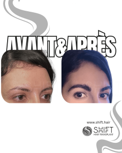 Avant Après une greffe de sourcils en Turquie chez SHIFT Hair à Istanbul 31 3