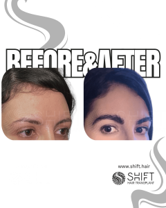 Eyebrow Transplant Turkey Before After SHIFT Hair Transplant in Istanbul 34 3