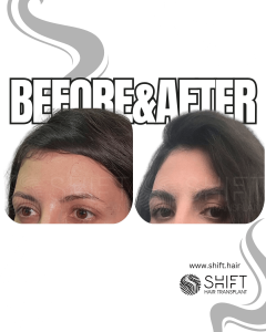 Eyebrow Transplant Turkey Before After SHIFT Hair Transplant in Istanbul 35 3