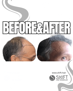 Hair Transplant Turkey Before After Norwood 6 Baldness SHIFT Hair Transplant in Istanbul 19 3