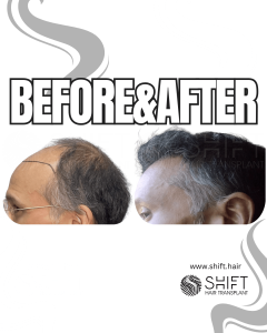 Hair Transplant Turkey Before After Norwood 6 Baldness SHIFT Hair Transplant in Istanbul 20 3
