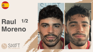 A thumbnail for a beard transplant video testimonial at SHIFT Hair in Turkey by Mr Raul Moreno 1 3