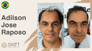 A thumbnail for a hair transplant video testimonial at SHIFT Hair in Turkey by Mr Adilson Jose Raposo