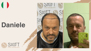 A thumbnail for a hair transplant video testimonial at SHIFT Hair in Turkey by Mr Daniele