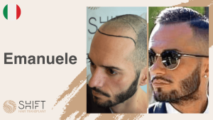A thumbnail for a hair transplant video testimonial at SHIFT Hair in Turkey by Mr Emanuele