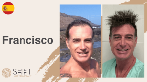 A thumbnail for a hair transplant video testimonial at SHIFT Hair in Turkey by Mr Francisco
