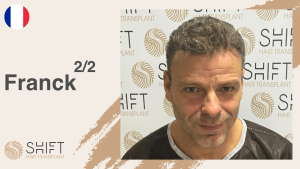 A thumbnail for a hair transplant video testimonial at SHIFT Hair in Turkey by Mr Franck 2