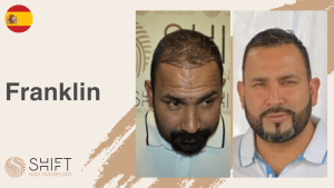 A thumbnail for a hair transplant video testimonial at SHIFT Hair in Turkey by Mr Franklin