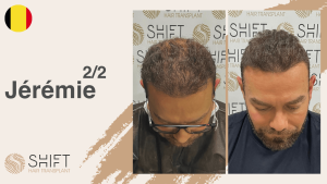 A thumbnail for a hair transplant video testimonial at SHIFT Hair in Turkey by Mr Jérémie 2