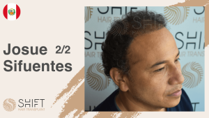 A thumbnail for a hair transplant video testimonial at SHIFT Hair in Turkey by Mr Josue Sifuentes 2