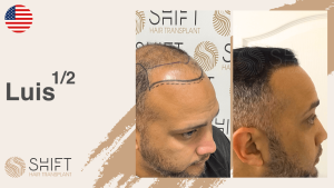 A thumbnail for a hair transplant video testimonial at SHIFT Hair in Turkey by Mr Luis 1