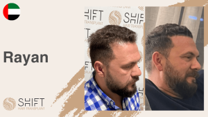 A thumbnail for a hair transplant video testimonial at SHIFT Hair in Turkey by Mr Rayan