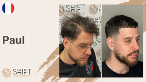 A thumbnail for a scalp micropigmentation video testimonial at SHIFT Hair in Turkey by Mr Paul