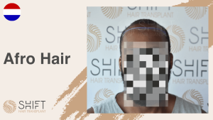 A thumbnail for an afro hair transplant video testimonial at SHIFT Hair in Turkey 3