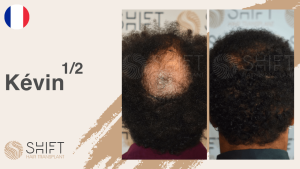 A thumbnail for an afro hair transplant video testimonial at SHIFT Hair in Turkey by Mr Kévin 1