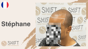 A thumbnail for an afro hair transplant video testimonial at SHIFT Hair in Turkey by Mr Stéphane