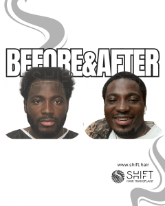 Afro Hair Transplant Turkey Before After SHIFT Hair Transplant in Istanbul 43 3