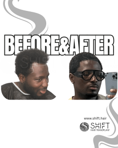 Afro Hair Transplant Turkey Before After SHIFT Hair Transplant in Istanbul 44 3