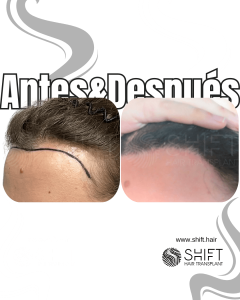 Antes Después de un trasplante de cabello para mujeres en Turquía en SHIFT Hair en Estambul 15 3
