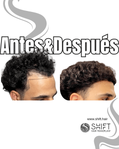 Antes y después de un trasplante capilar para la calvicie de Norwood 3 en Turquía en SHIFT Hair en Estambul 34 3