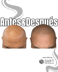 Antes y después de una micropigmentación capilar para un look afeitado en Turquía en SHIFT Hair en Estambul 50 3