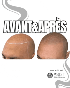 Avant Après de la micropigmentation du cuir chevelu pour un look rasé en Turquie chez SHIFT Hair à Istanbul 52 3