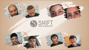 Les témoignages vidéo de la greffe de cheveux SHIFT en Turquie